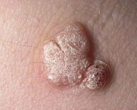 Đốt Mụn Cóc