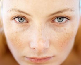 Điều trị xóa nám