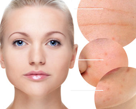 Điều trị mụn trứng cá