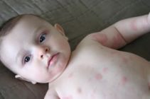 Có phải vệ sinh quá sạch dễ khiến trẻ em bị eczema? 