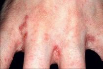 Bệnh ghẻ ngứa có điều trị dứt điểm được không? 