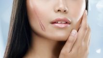 Điều trị sẹo lồi như thế nào? 